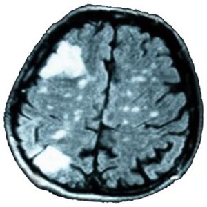Mozog oblasti sivej hmoty